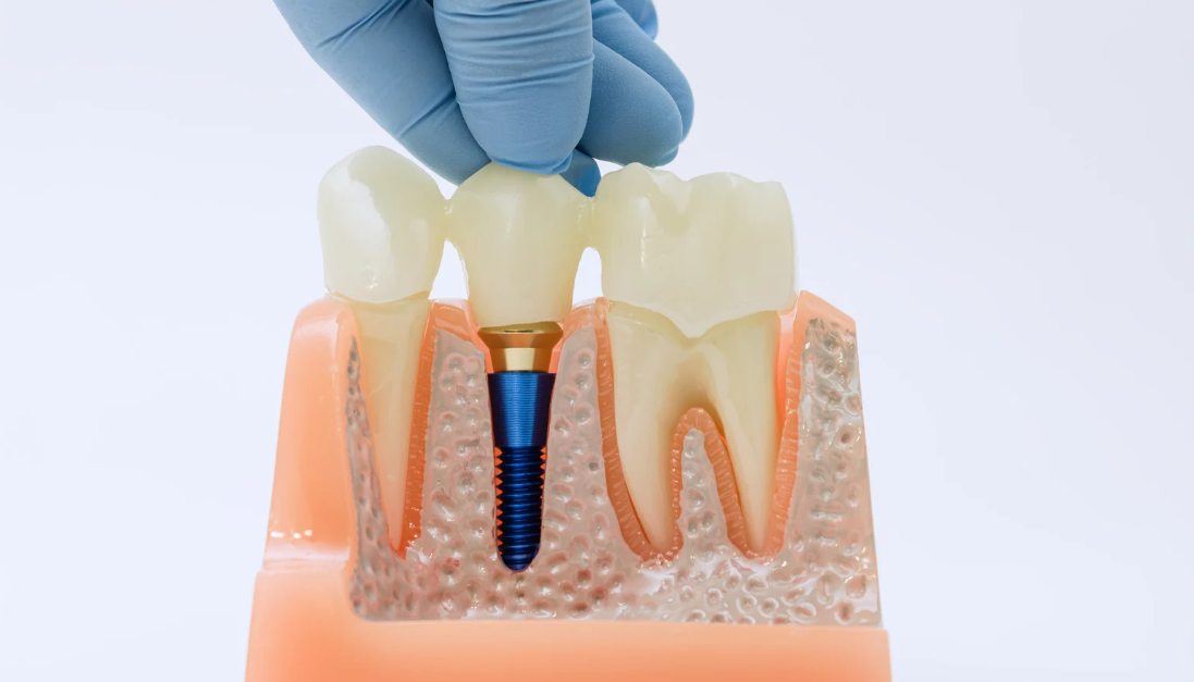 Dental Implant Practices
